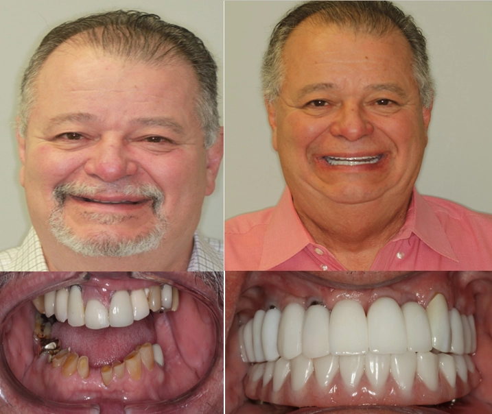 Dental Implant Transformation